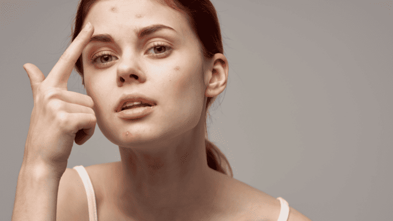 The Best Natural Ingredients To Treat Acne-Prone Skin!