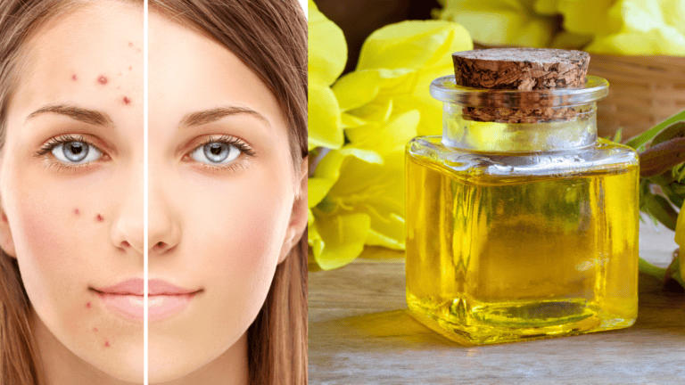 evening primrose oil for problem skin blog