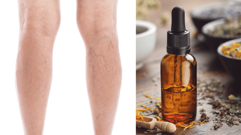 spider veins essesntial oil blog